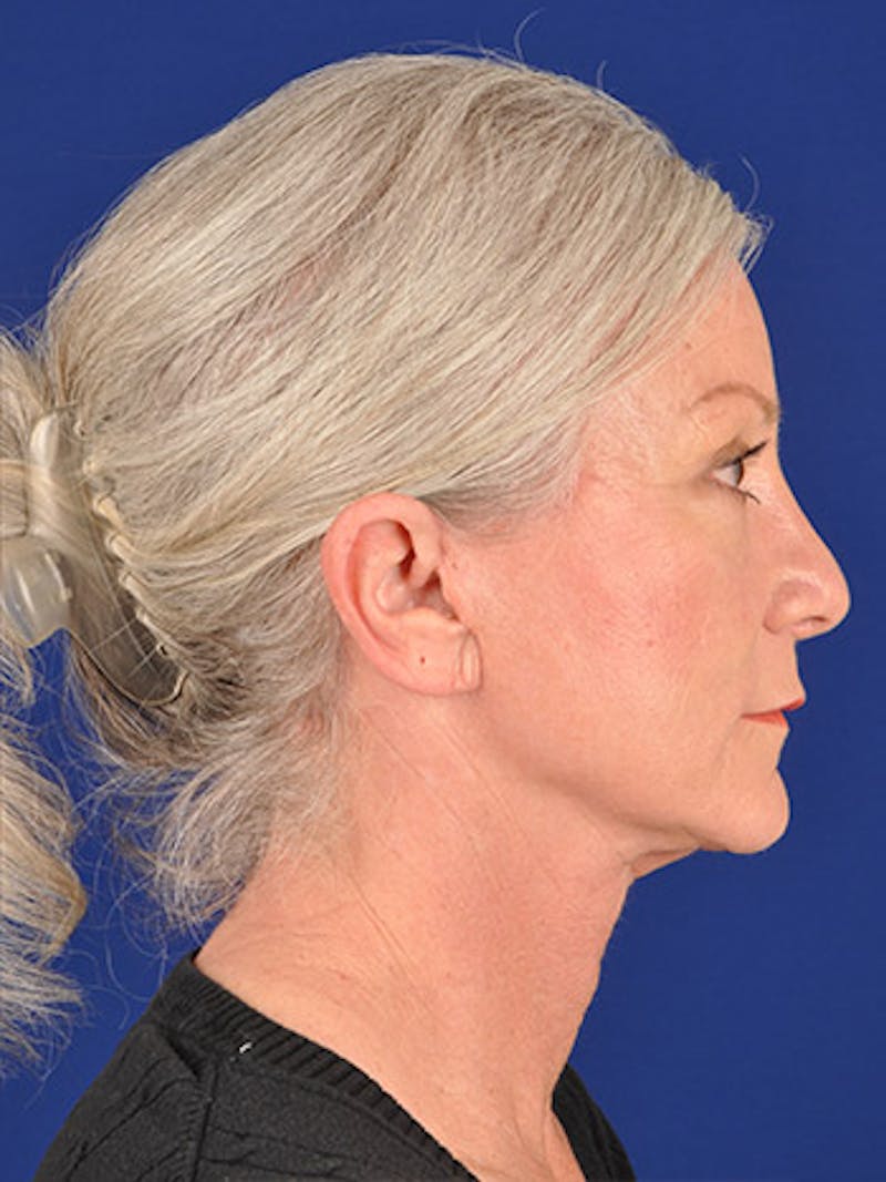 Facelift Before & After Gallery - Patient 10670349 - Image 6