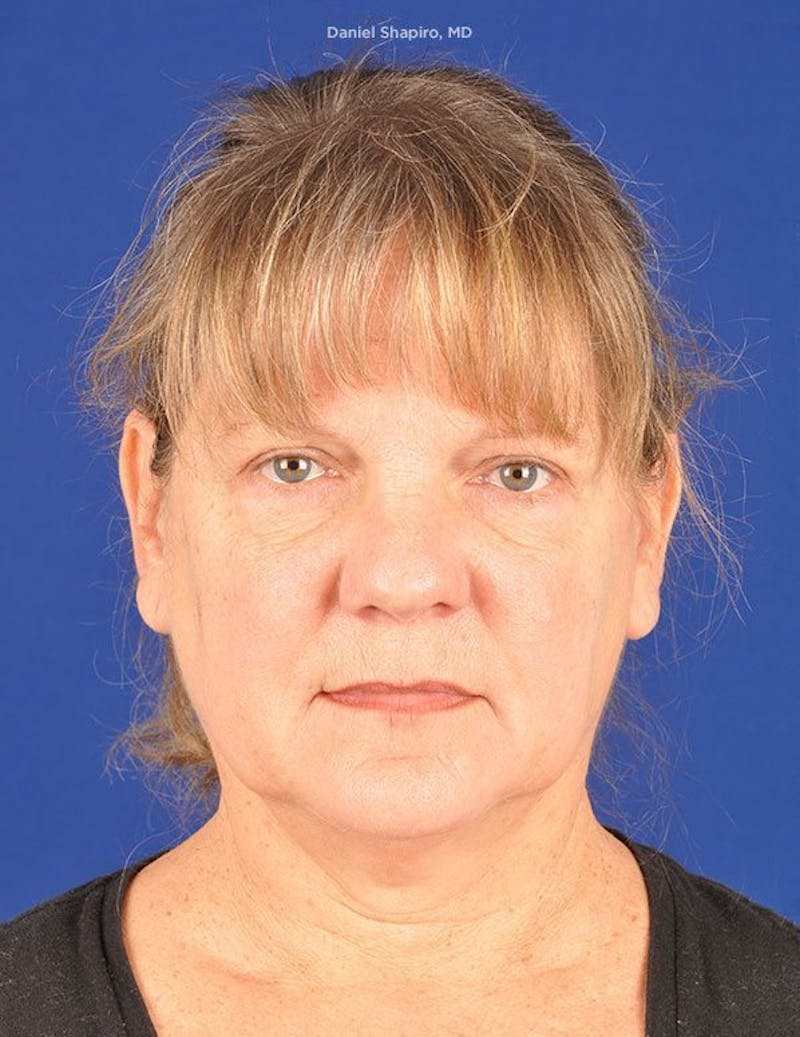 Facelift Before & After Gallery - Patient 10670352 - Image 1