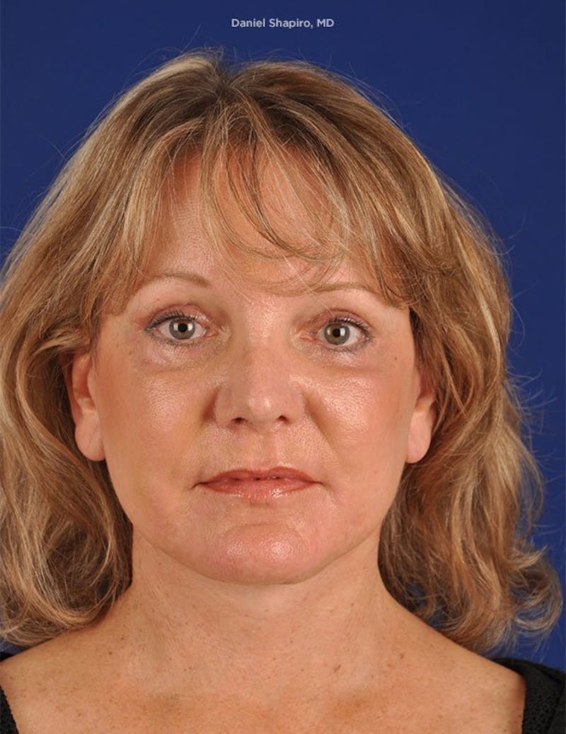 Facelift Before & After Gallery - Patient 10670352 - Image 2