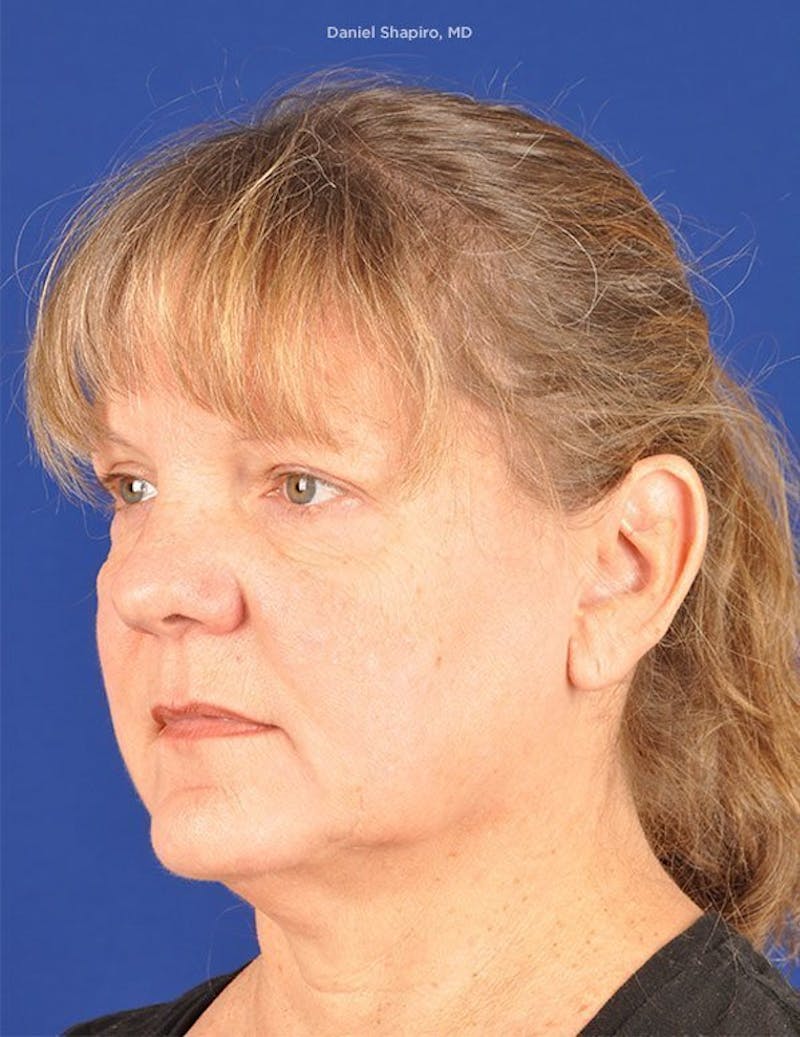 Facelift Before & After Gallery - Patient 10670352 - Image 3