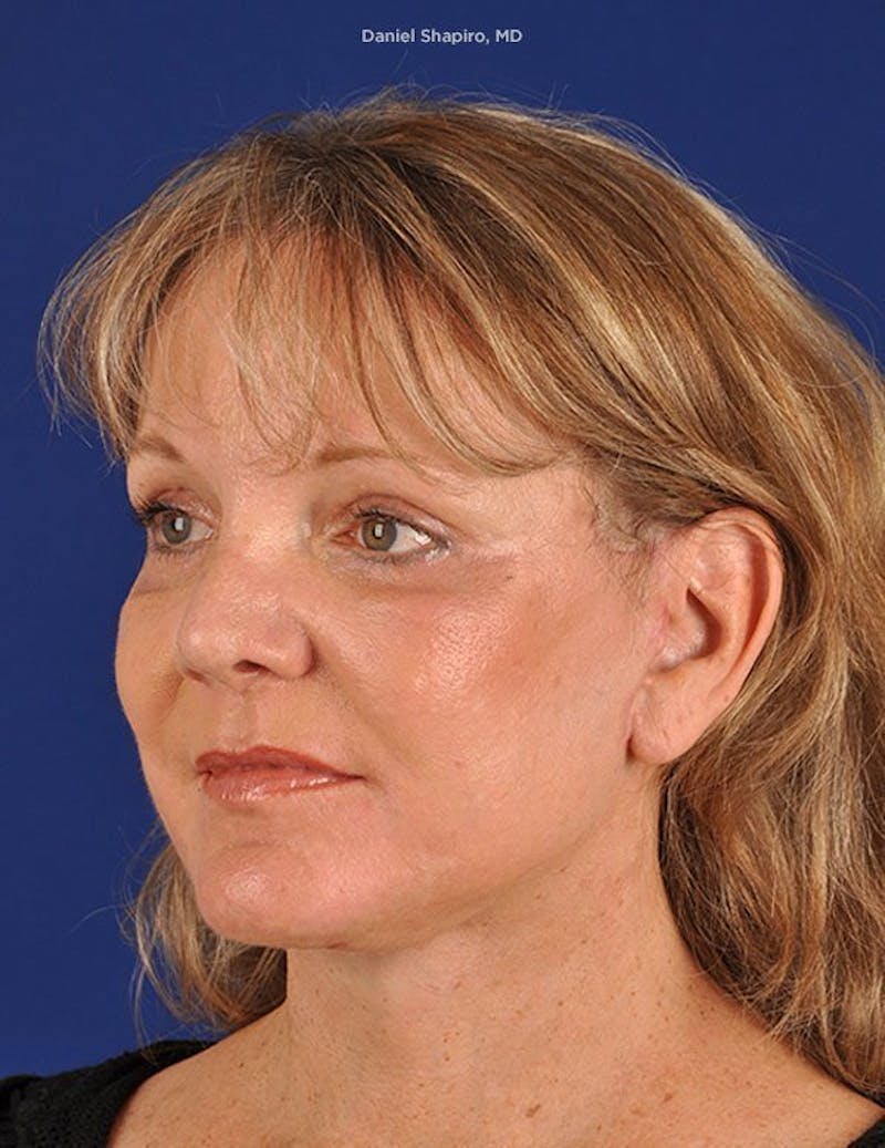 Facelift Before & After Gallery - Patient 10670352 - Image 4