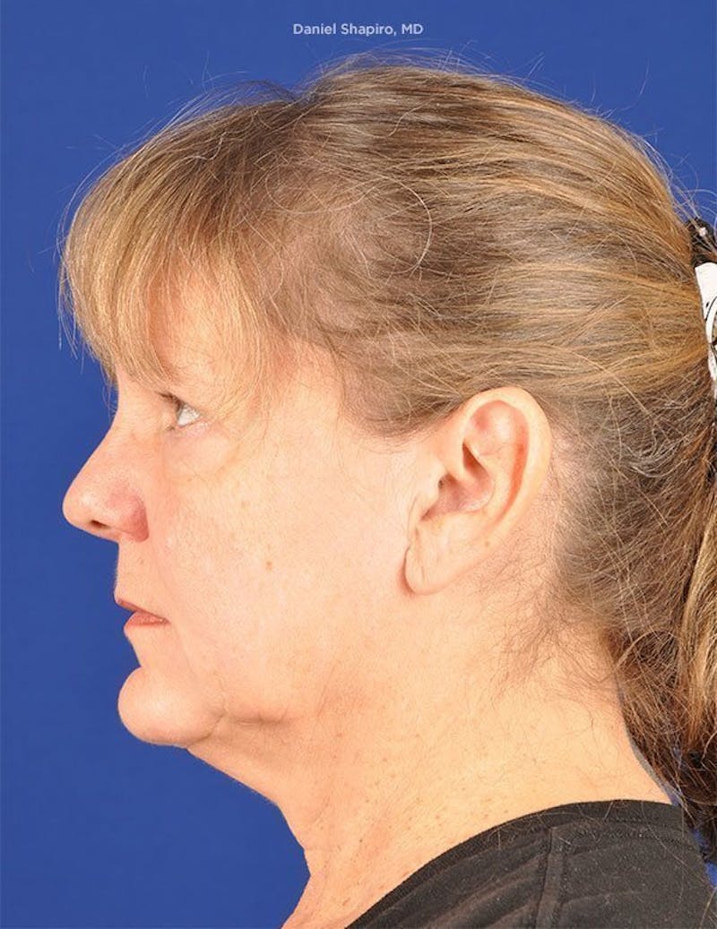 Facelift Before & After Gallery - Patient 10670352 - Image 5