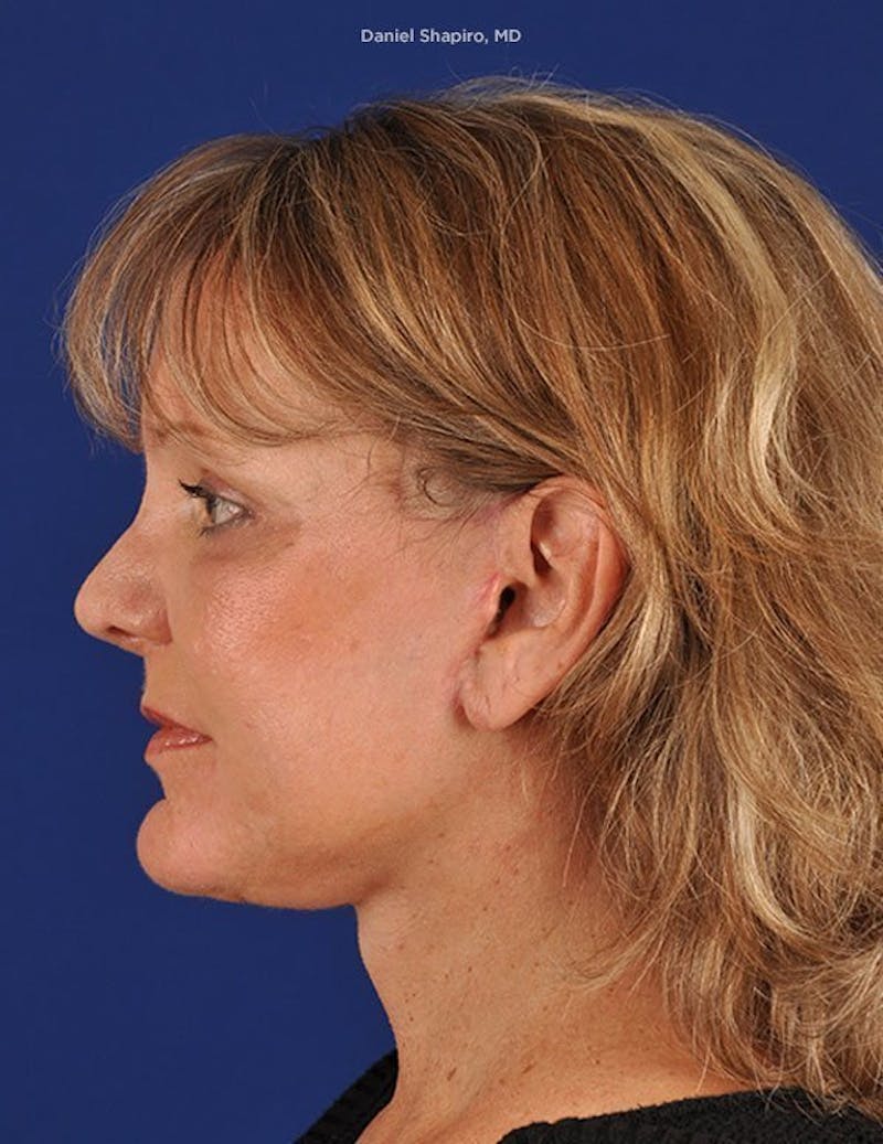 Facelift Before & After Gallery - Patient 10670352 - Image 6