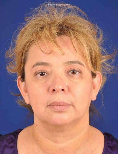 Facelift Before & After Gallery - Patient 10670358 - Image 1
