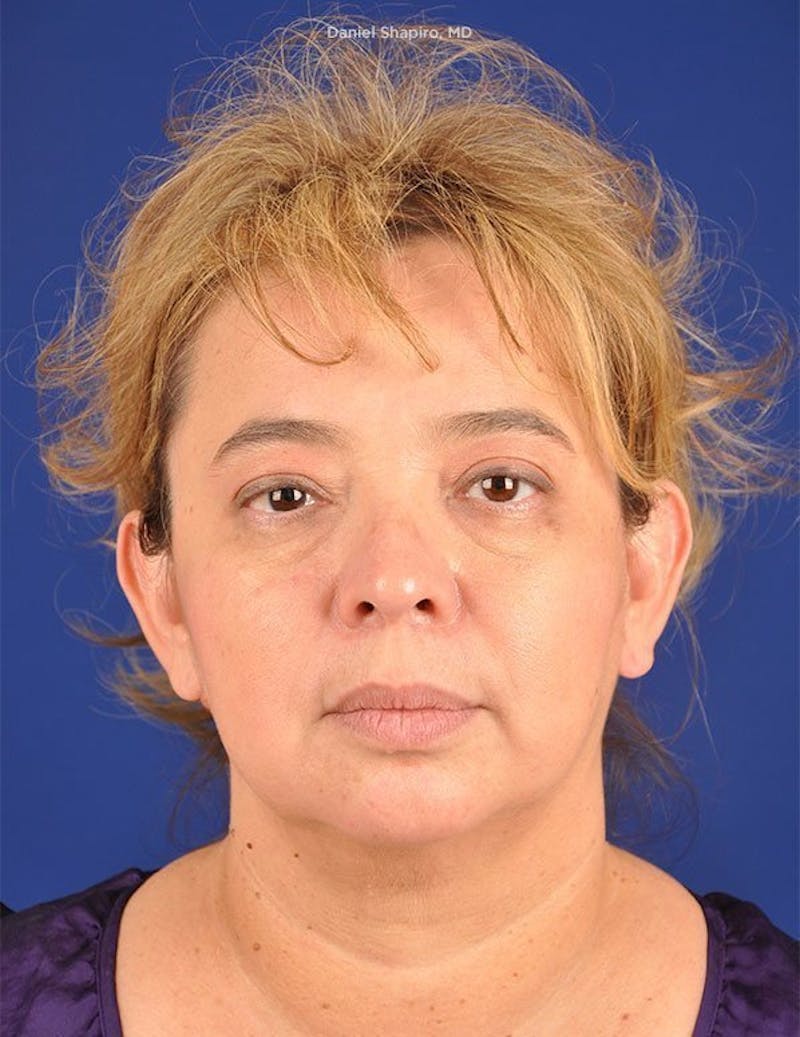 Facelift Before & After Gallery - Patient 10670358 - Image 1