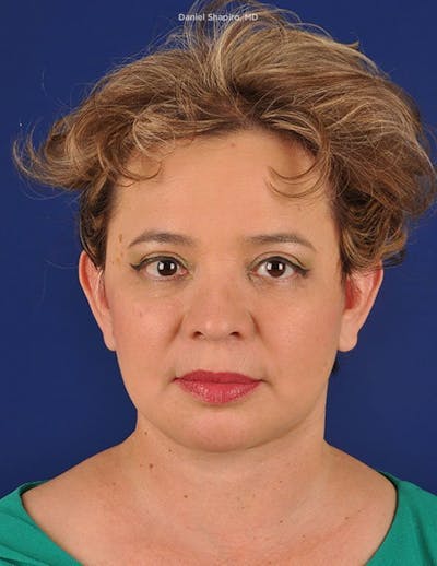 Facelift Before & After Gallery - Patient 10670358 - Image 2