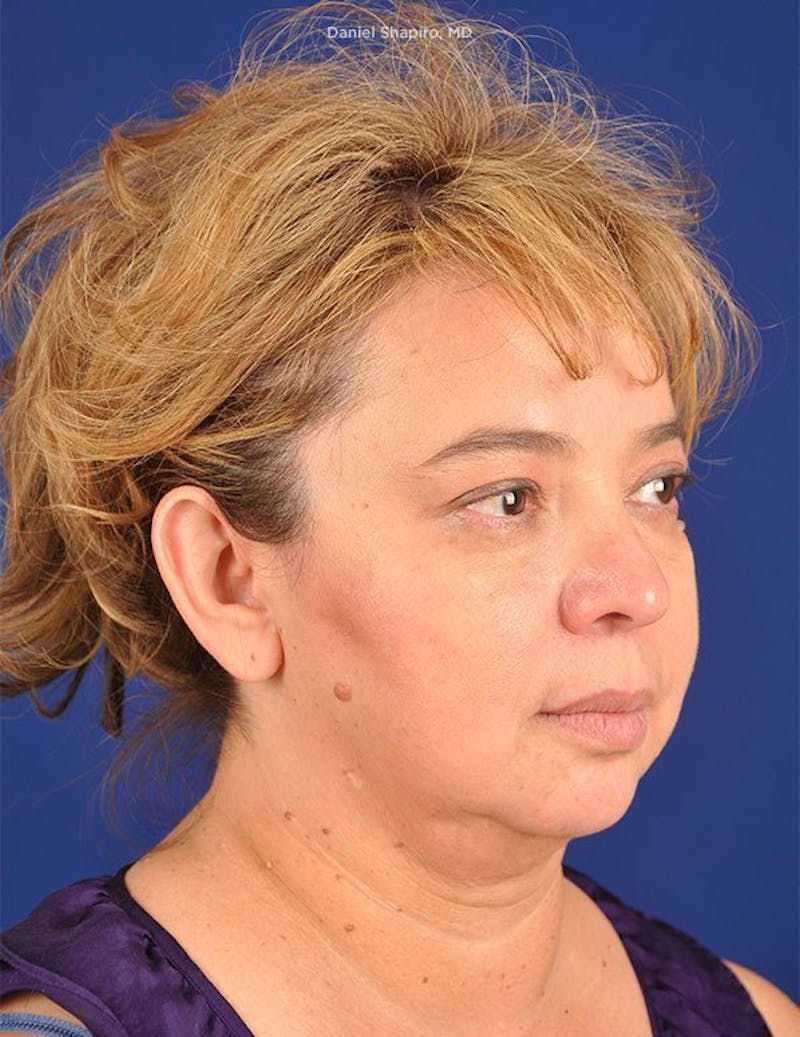 Facelift Before & After Gallery - Patient 10670358 - Image 3