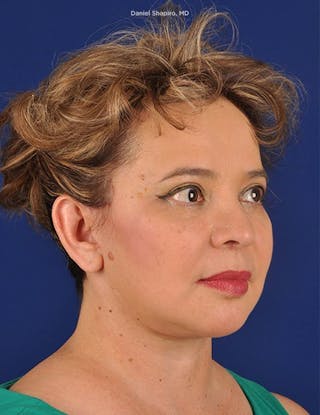 Facelift Before & After Gallery - Patient 10670358 - Image 4