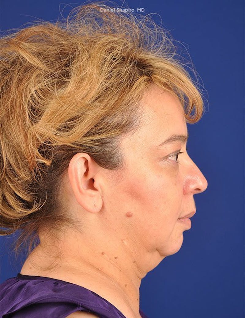 Facelift Before & After Gallery - Patient 10670358 - Image 5