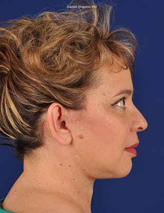 Facelift Before & After Gallery - Patient 10670358 - Image 6