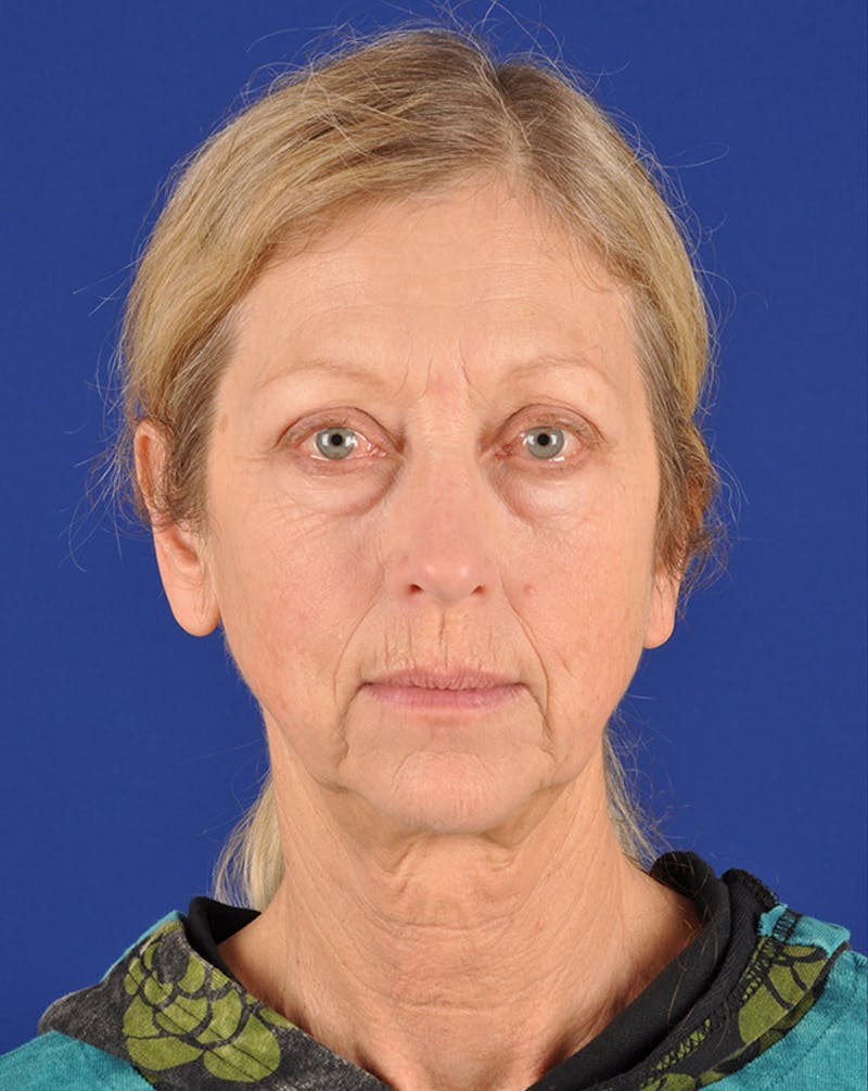 Facelift Before & After Gallery - Patient 10670364 - Image 1