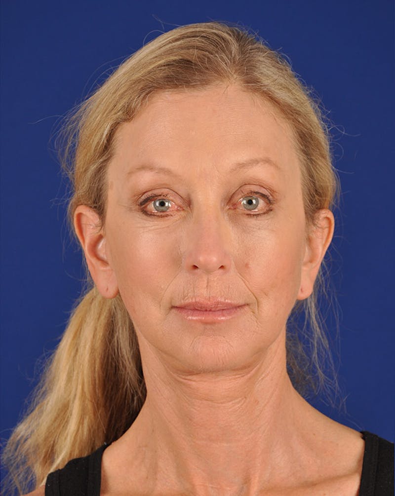 Facelift Before & After Gallery - Patient 10670364 - Image 2