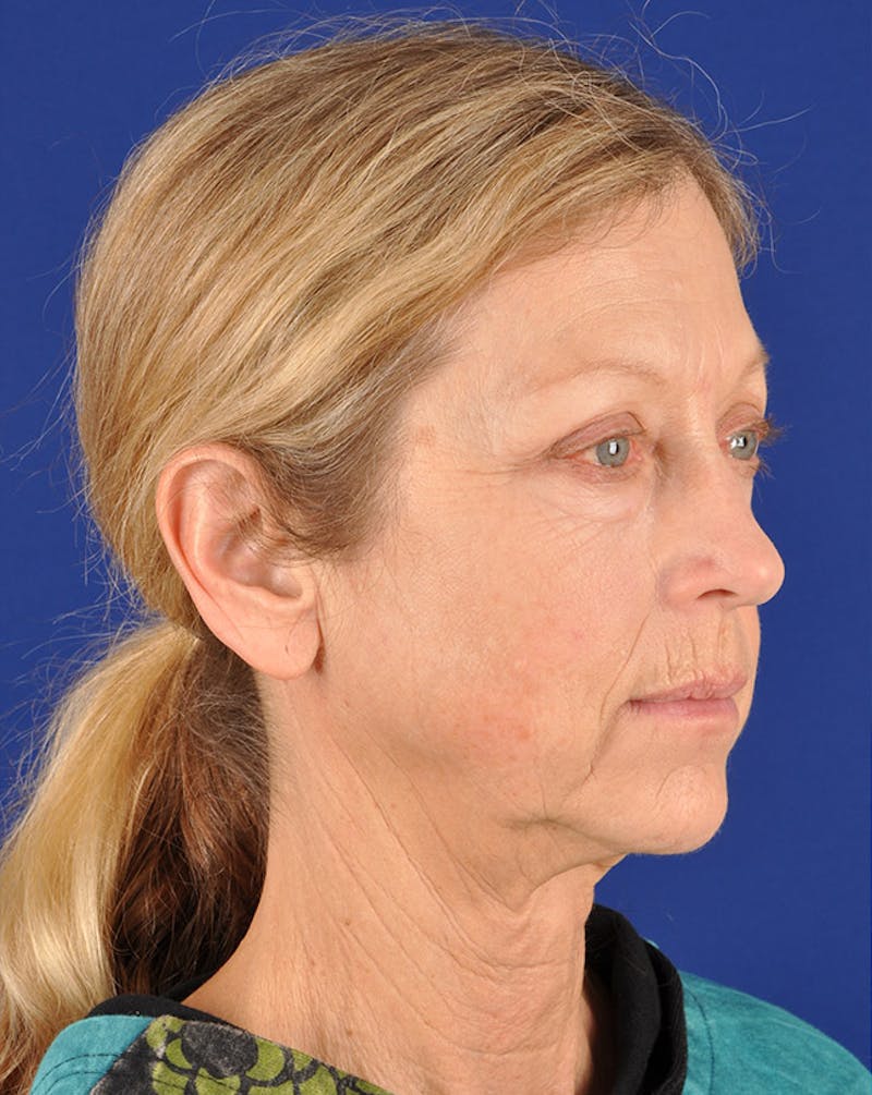 Facelift Before & After Gallery - Patient 10670364 - Image 3