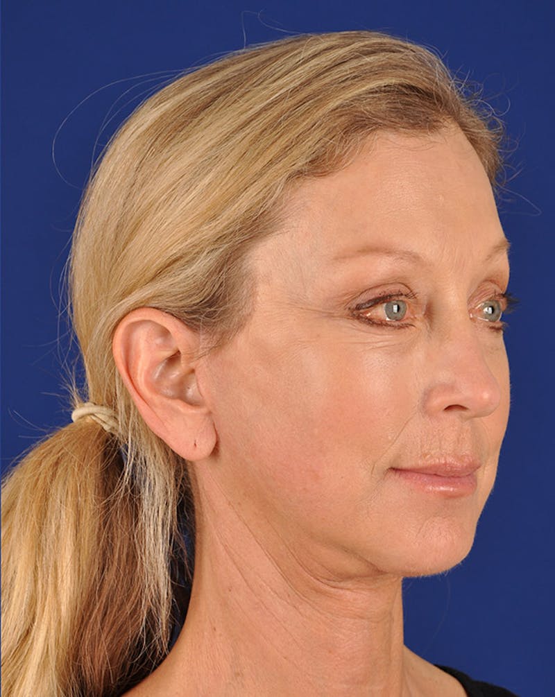 Facelift Before & After Gallery - Patient 10670364 - Image 4