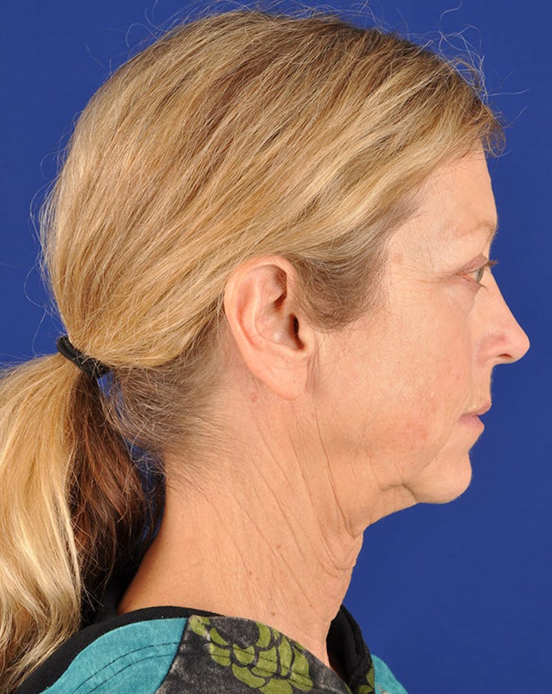 Facelift Before & After Gallery - Patient 10670364 - Image 5