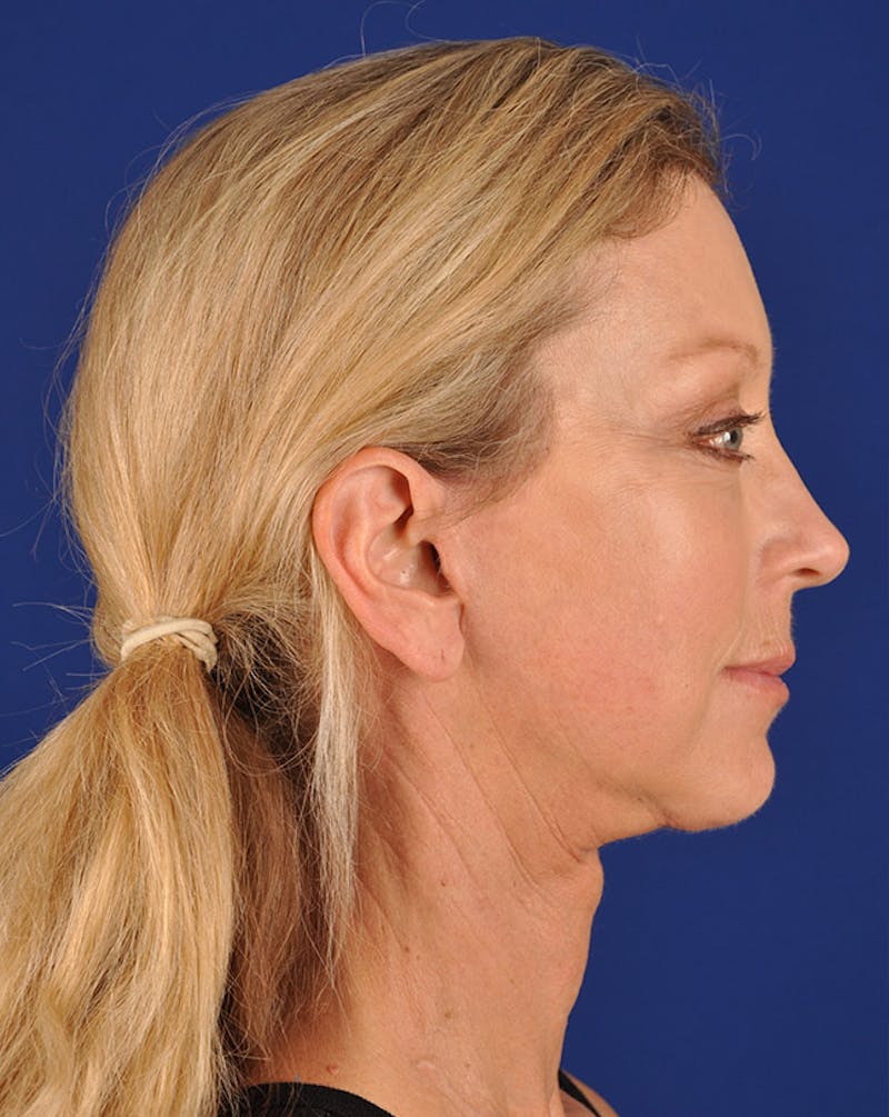 Facelift Before & After Gallery - Patient 10670364 - Image 6
