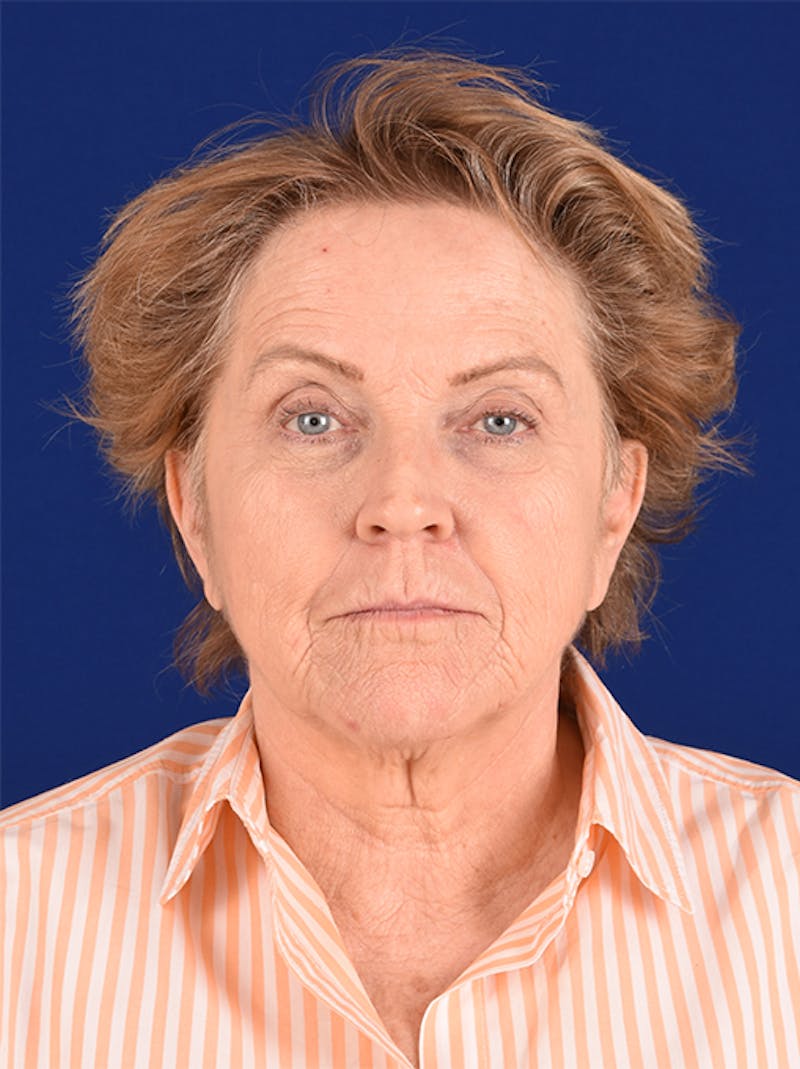 Facelift Before & After Gallery - Patient 10670372 - Image 1