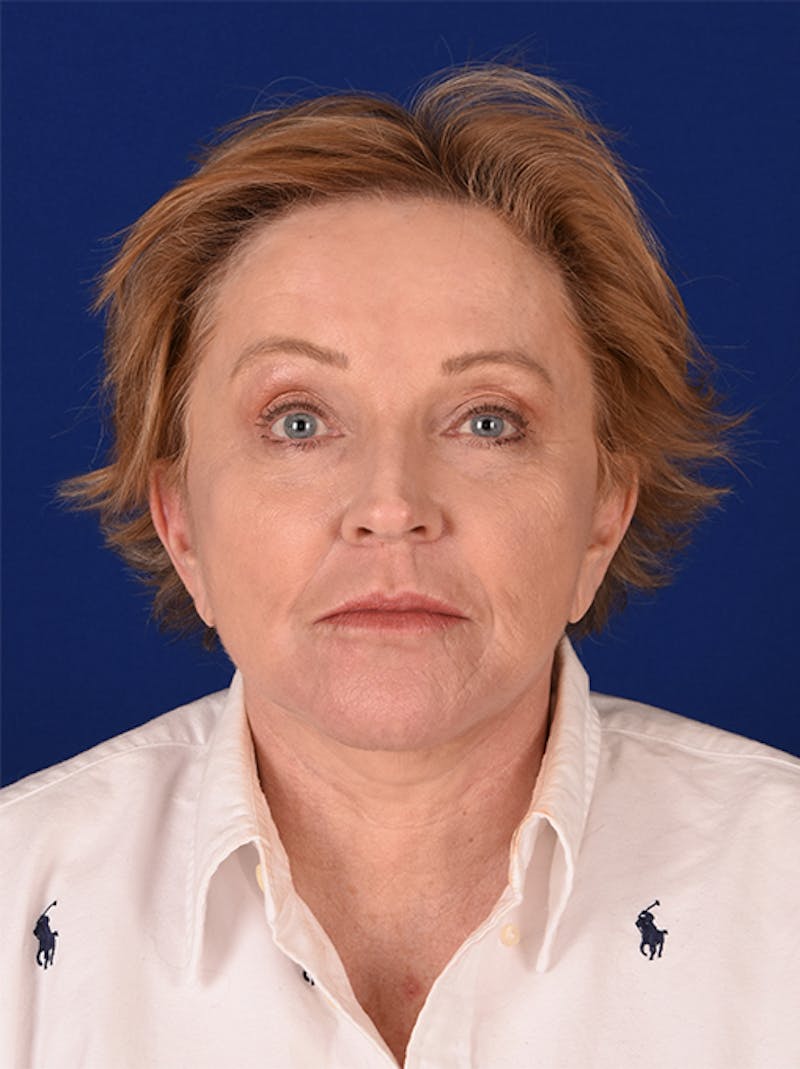 Facelift Before & After Gallery - Patient 10670372 - Image 2
