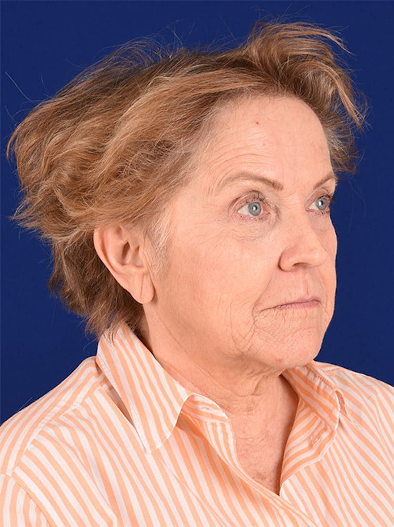 Facelift Before & After Gallery - Patient 10670372 - Image 3