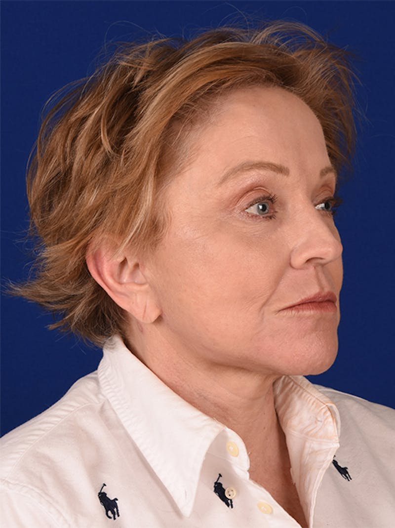 Facelift Before & After Gallery - Patient 10670372 - Image 4