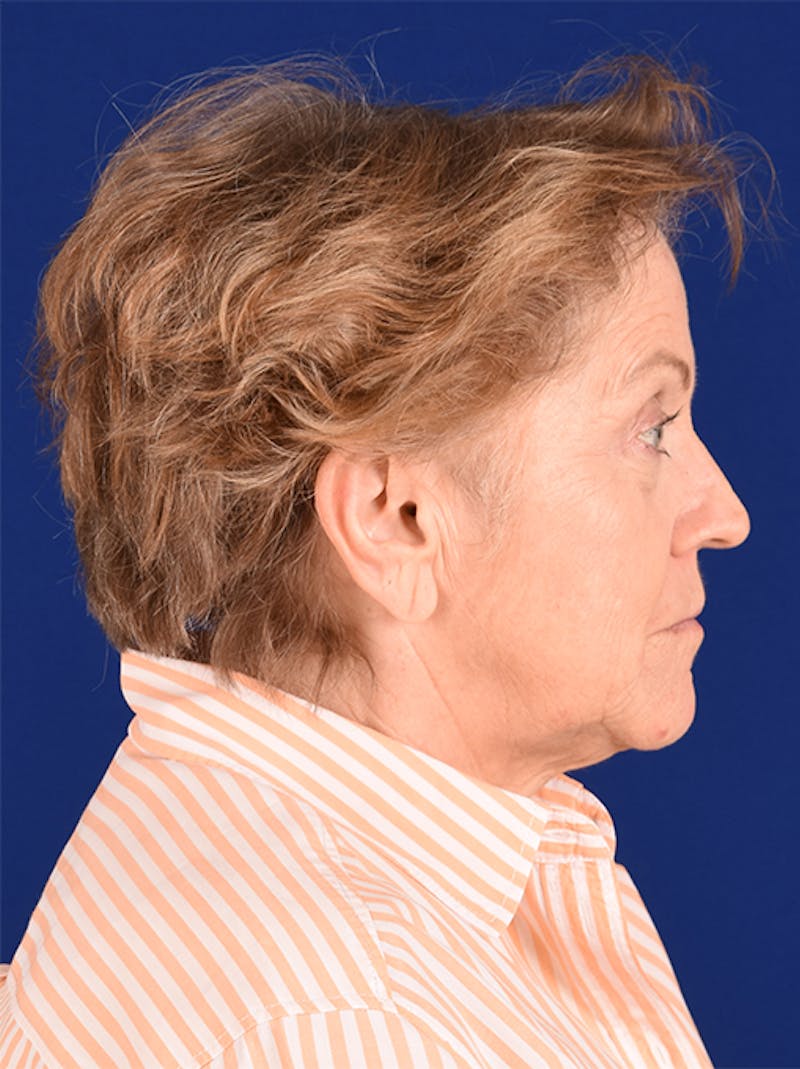 Facelift Before & After Gallery - Patient 10670372 - Image 5