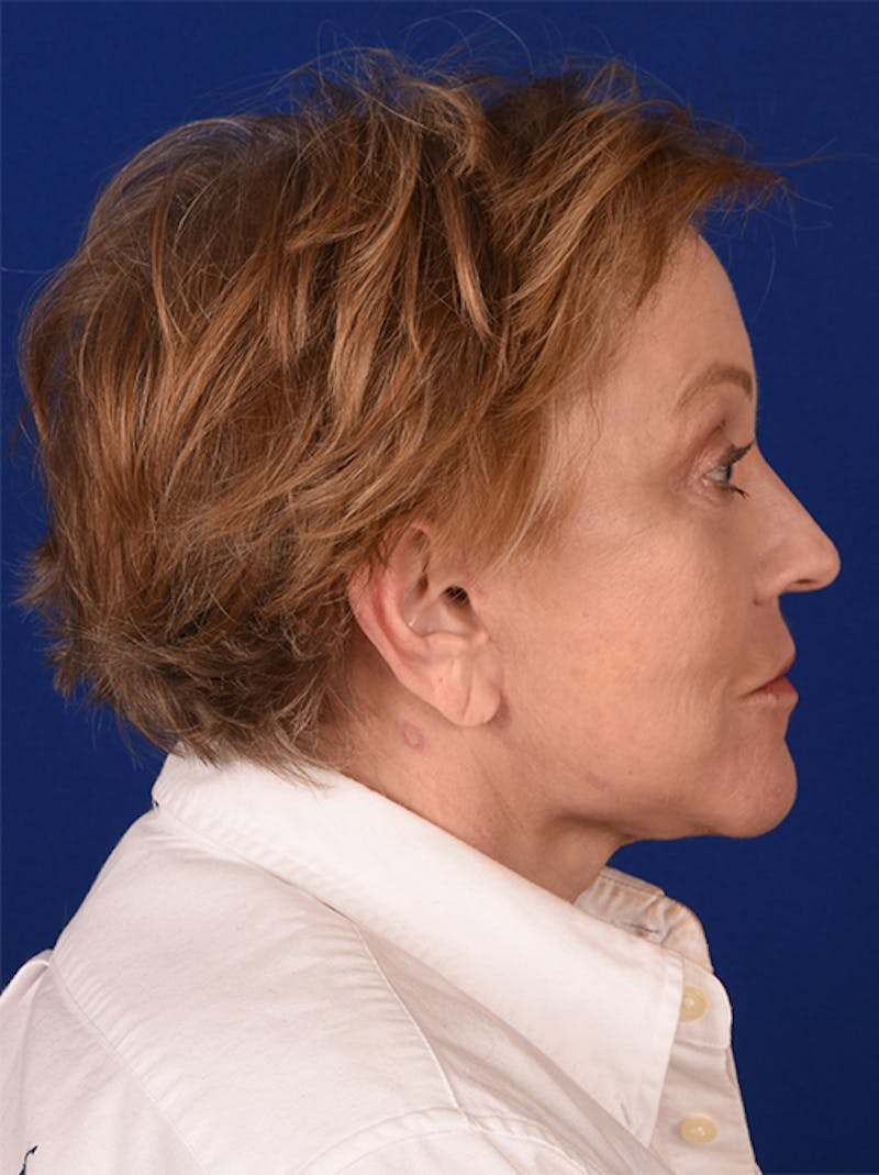 Facelift Before & After Gallery - Patient 10670372 - Image 6