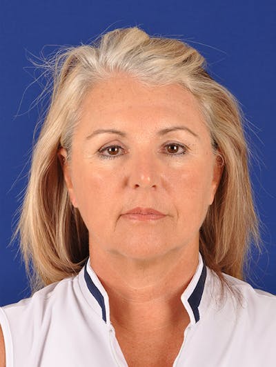 Facelift Before & After Gallery - Patient 10670378 - Image 1