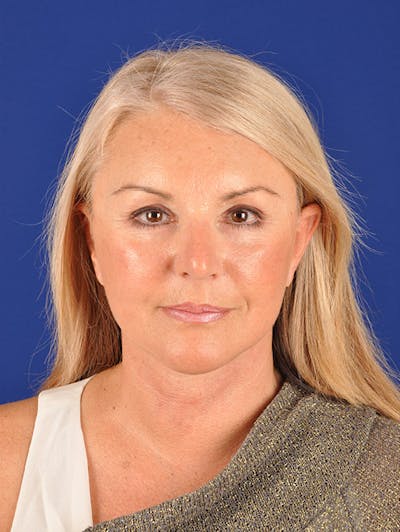 Facelift Before & After Gallery - Patient 10670378 - Image 2