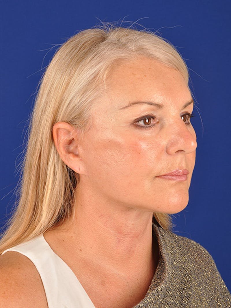 Facelift Before & After Gallery - Patient 10670378 - Image 4