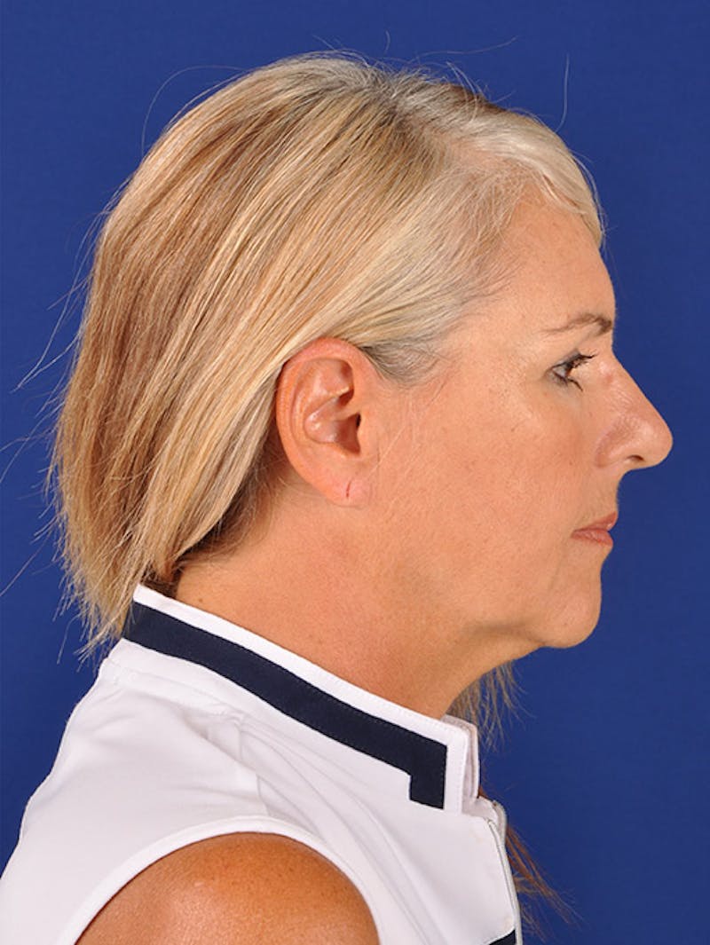 Facelift Before & After Gallery - Patient 10670378 - Image 5