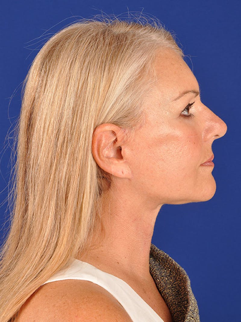 Facelift Before & After Gallery - Patient 10670378 - Image 6