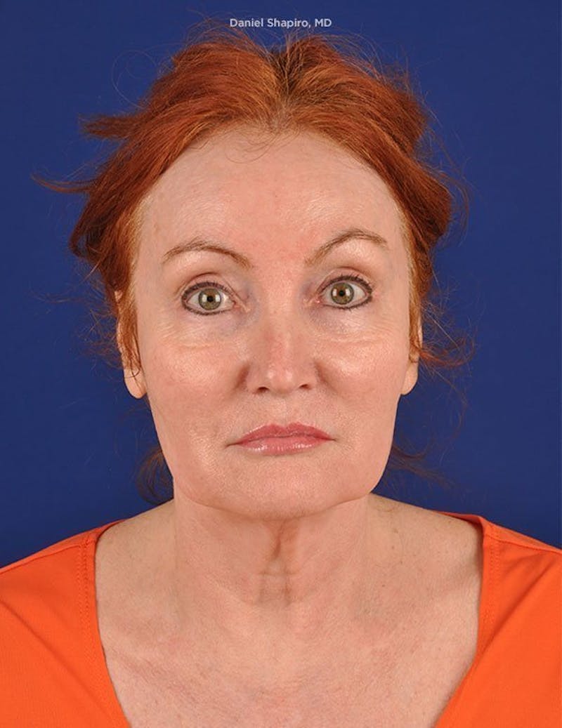 Facelift Before & After Gallery - Patient 10670384 - Image 1