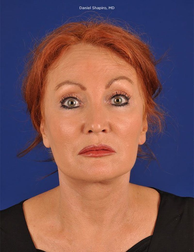Facelift Before & After Gallery - Patient 10670384 - Image 2