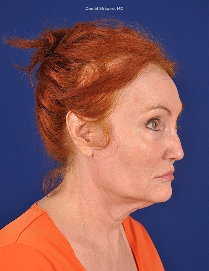 Facelift Before & After Gallery - Patient 10670384 - Image 3
