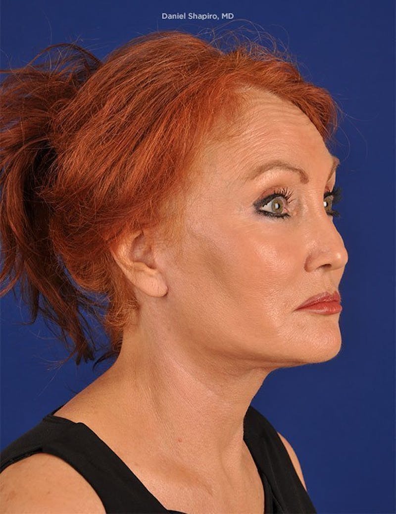 Facelift Before & After Gallery - Patient 10670384 - Image 4