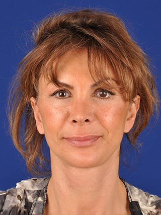Facelift Before & After Gallery - Patient 10670385 - Image 2