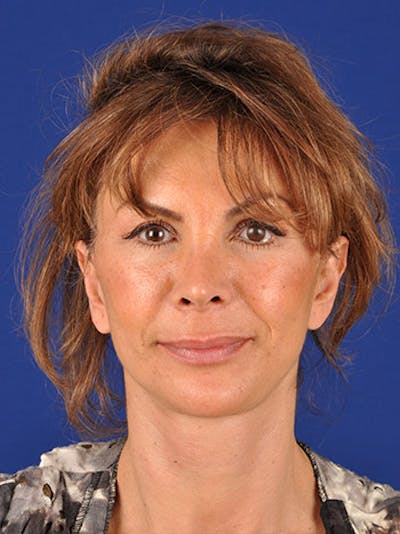 Facelift Before & After Gallery - Patient 10670385 - Image 2