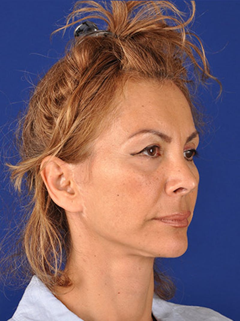 Facelift Before & After Gallery - Patient 10670385 - Image 3