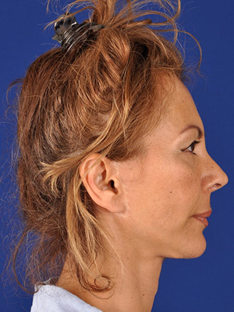 Facelift Before & After Gallery - Patient 10670385 - Image 5