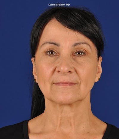 Facelift Before & After Gallery - Patient 10670391 - Image 1