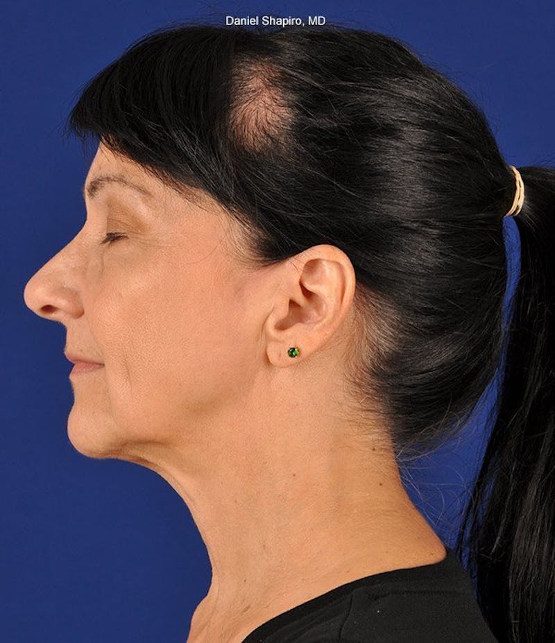 Facelift Before & After Gallery - Patient 10670391 - Image 5