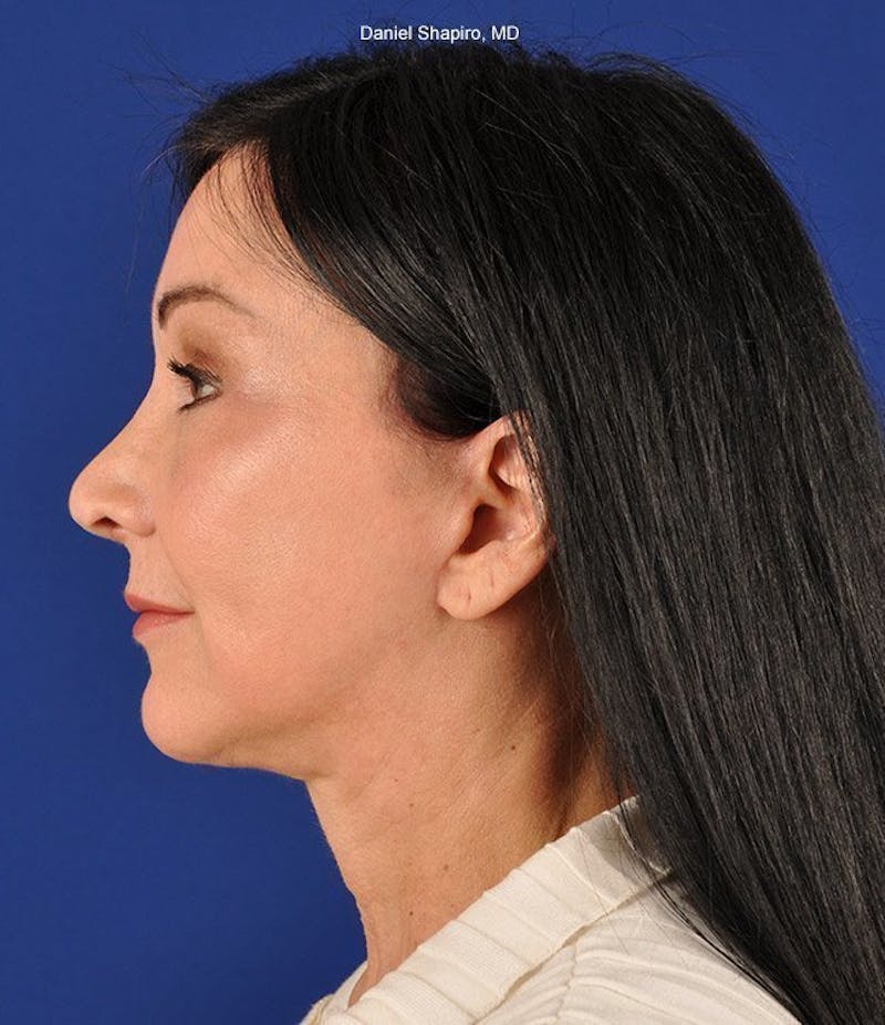 Facelift Before & After Gallery - Patient 10670391 - Image 6