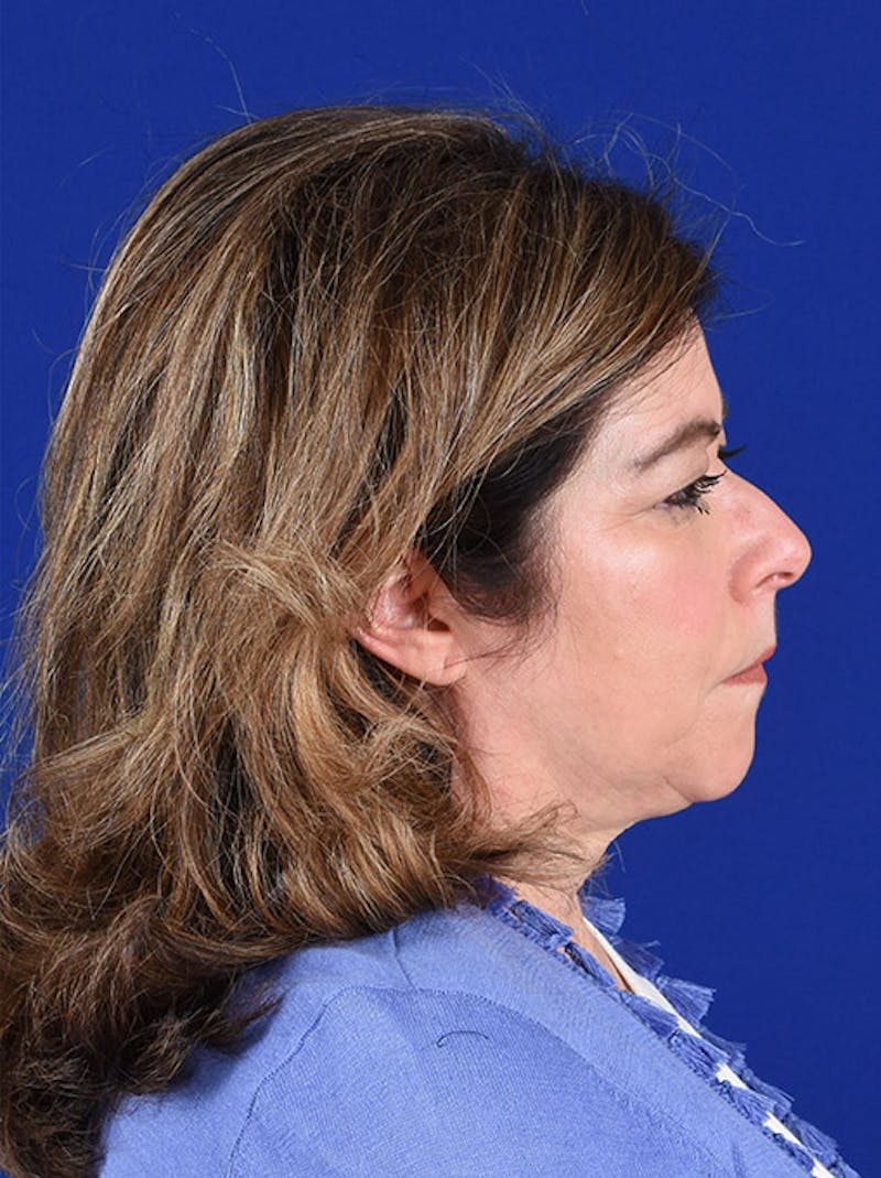 Facelift Before & After Gallery - Patient 10670398 - Image 5