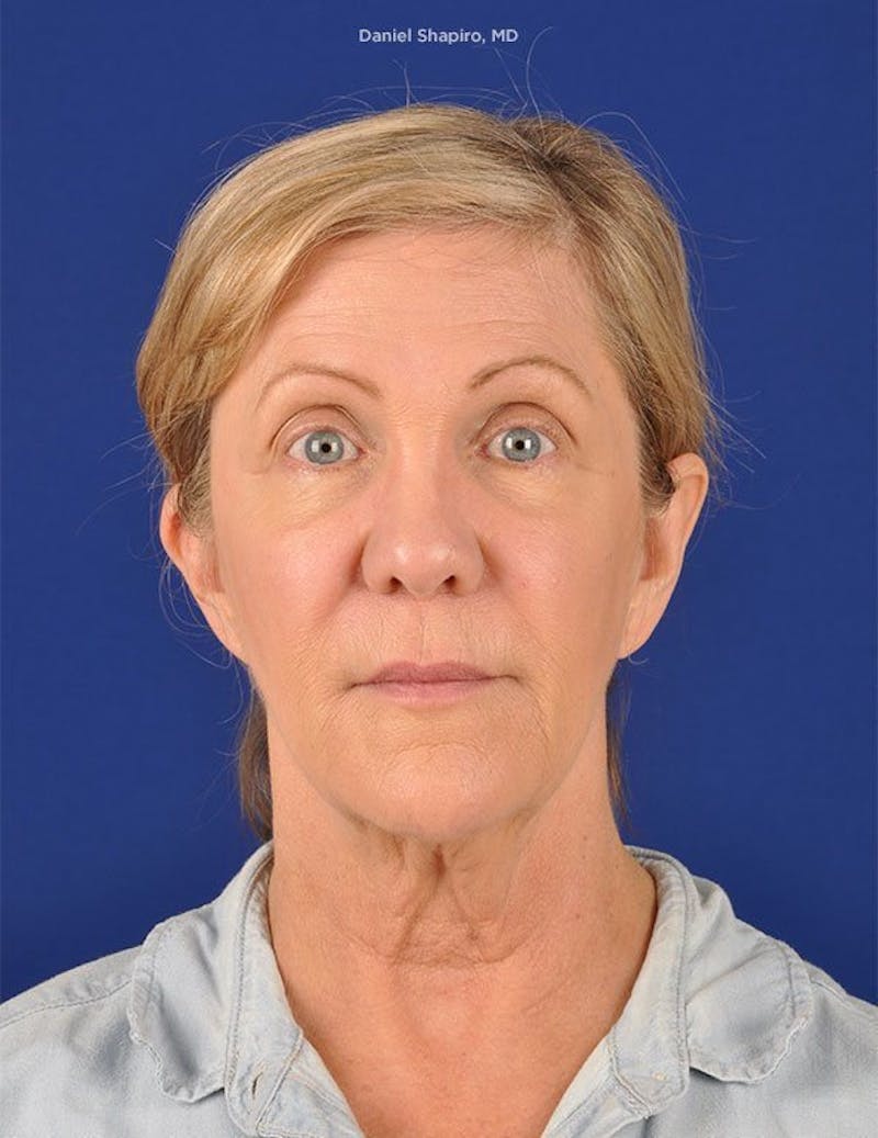 Facelift Before & After Gallery - Patient 10670404 - Image 1