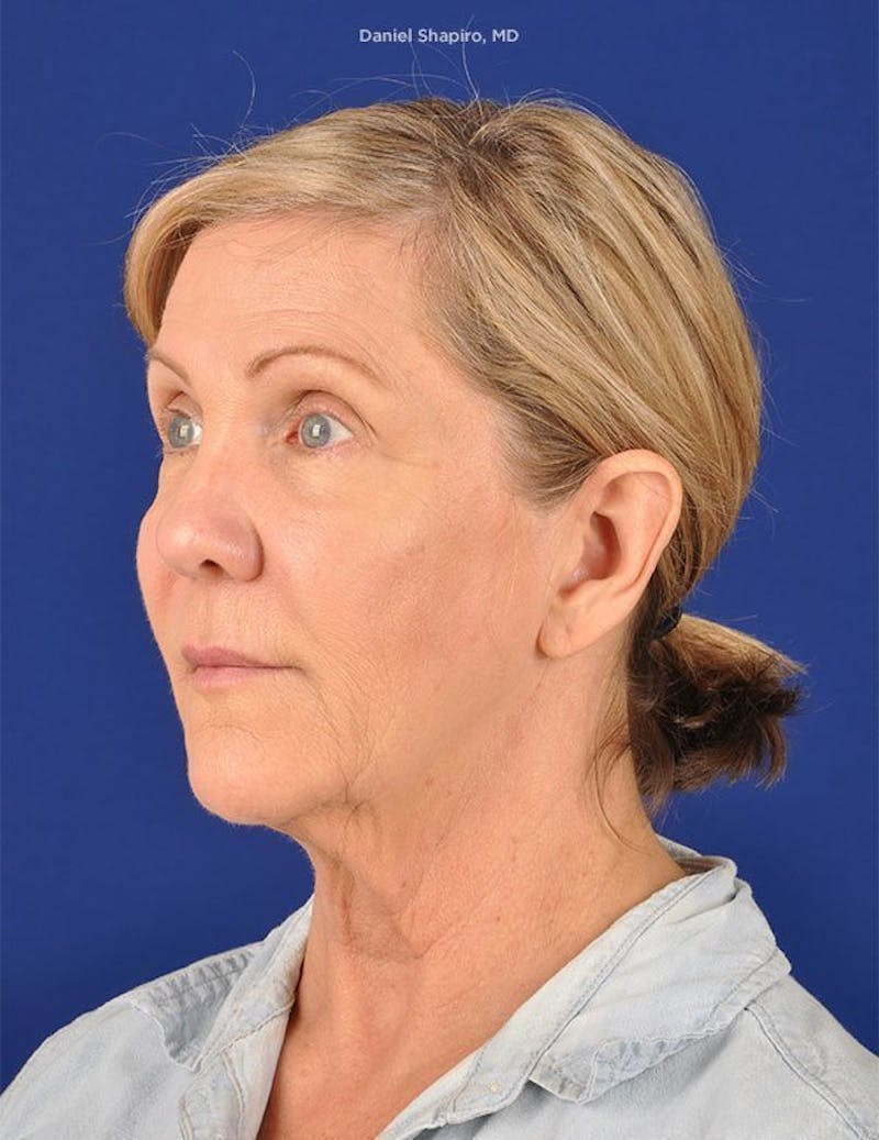 Facelift Before & After Gallery - Patient 10670404 - Image 3