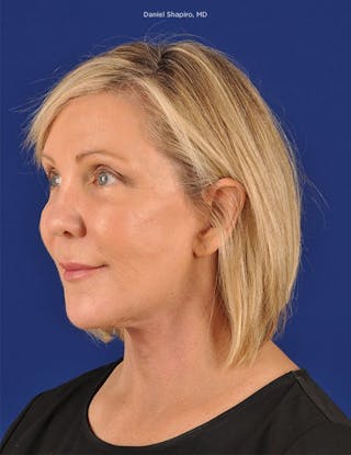 Facelift Before & After Gallery - Patient 10670404 - Image 4