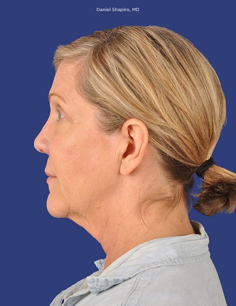 Facelift Before & After Gallery - Patient 10670404 - Image 5