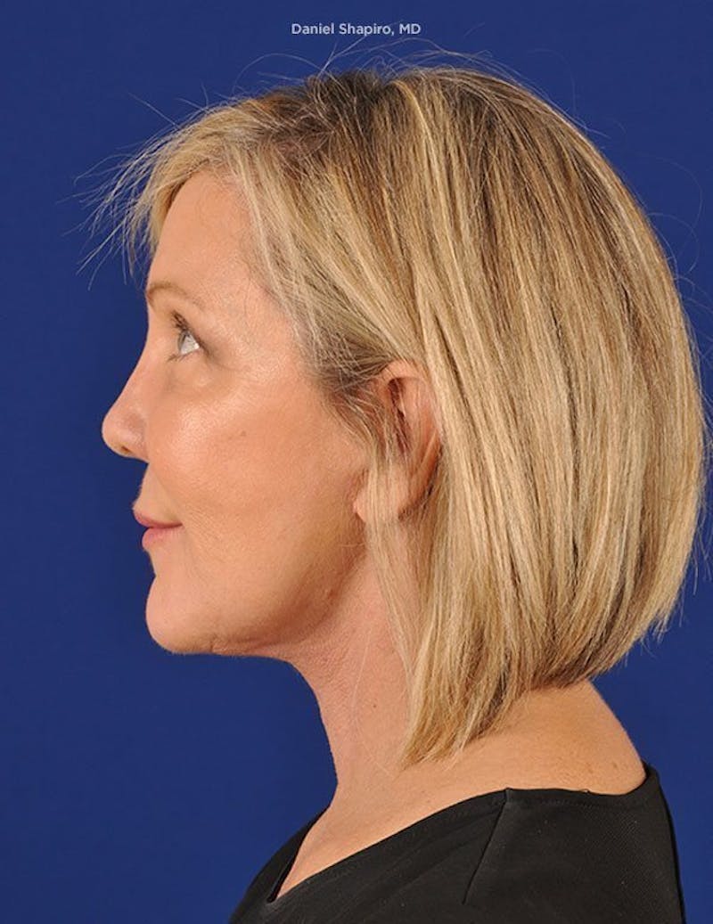 Facelift Before & After Gallery - Patient 10670404 - Image 6