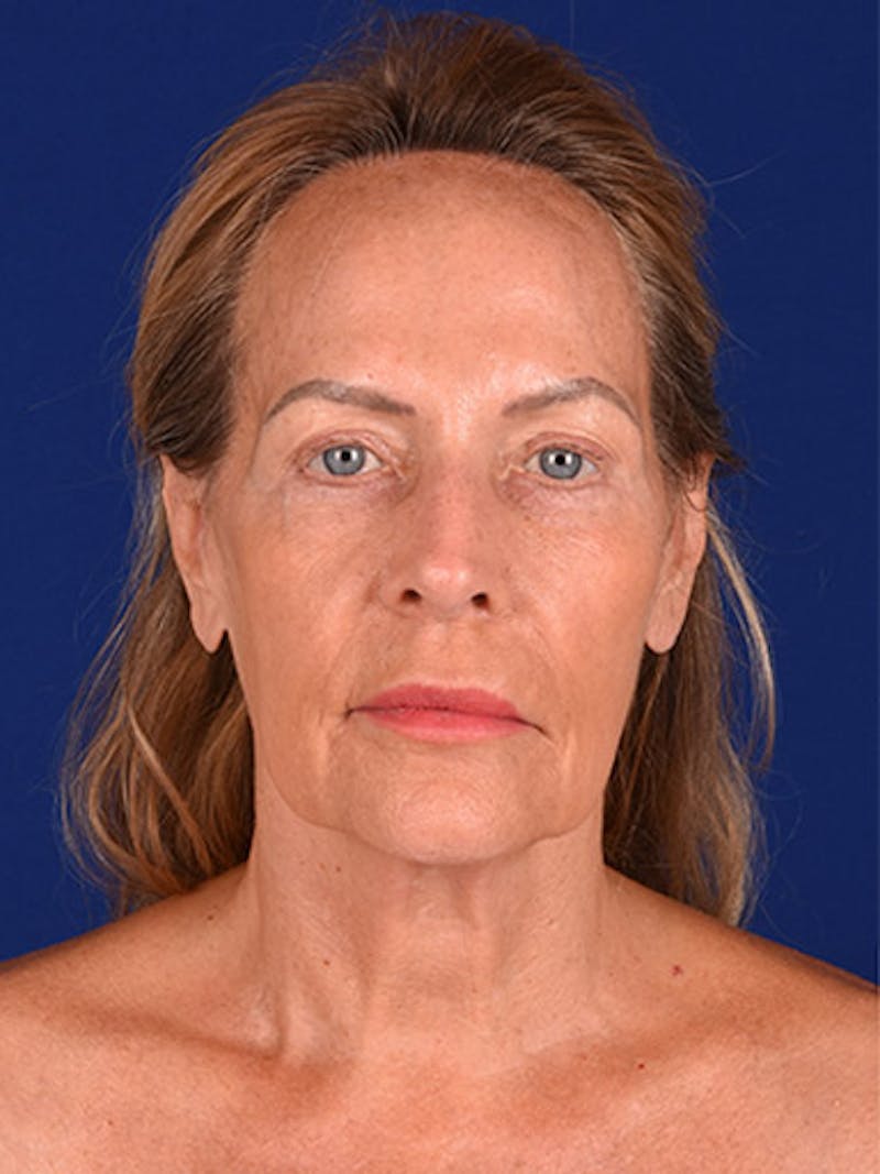 Facelift Before & After Gallery - Patient 10678690 - Image 1