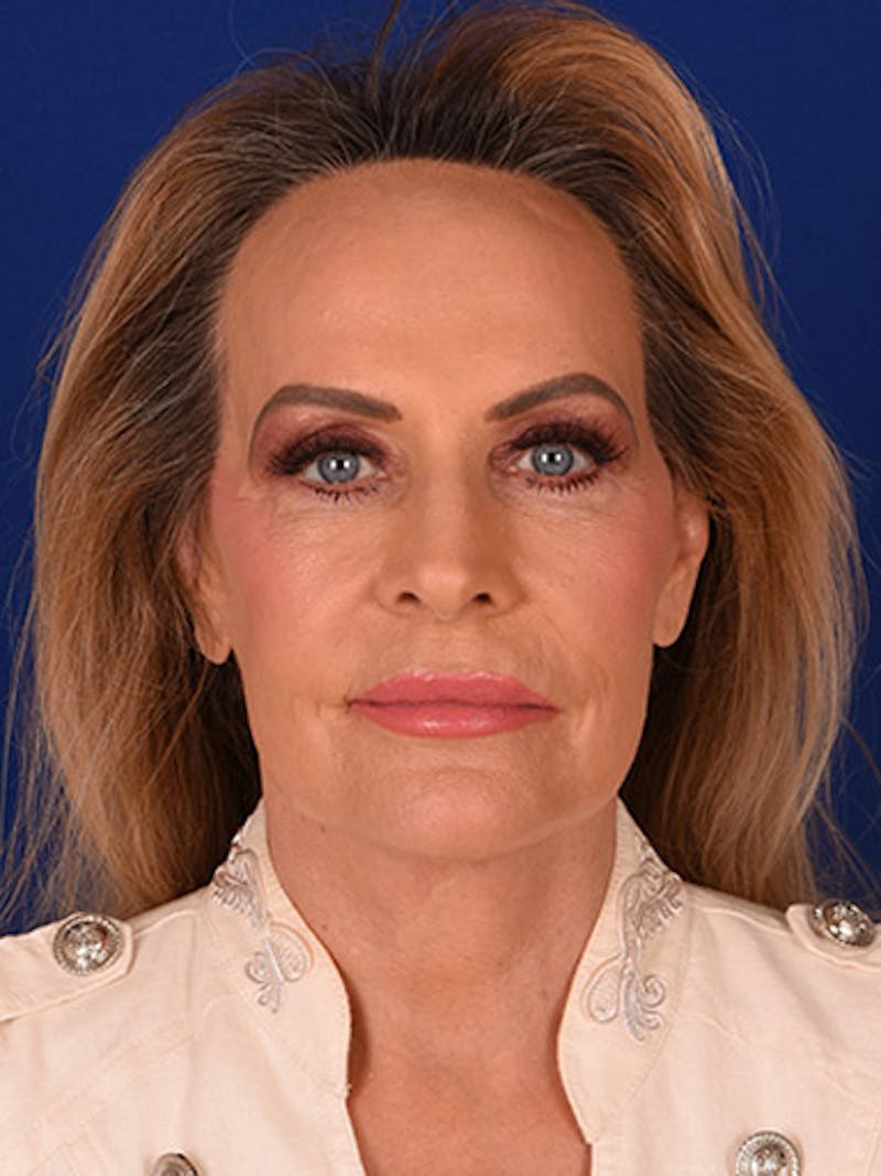 Facelift Before & After Gallery - Patient 10678690 - Image 2